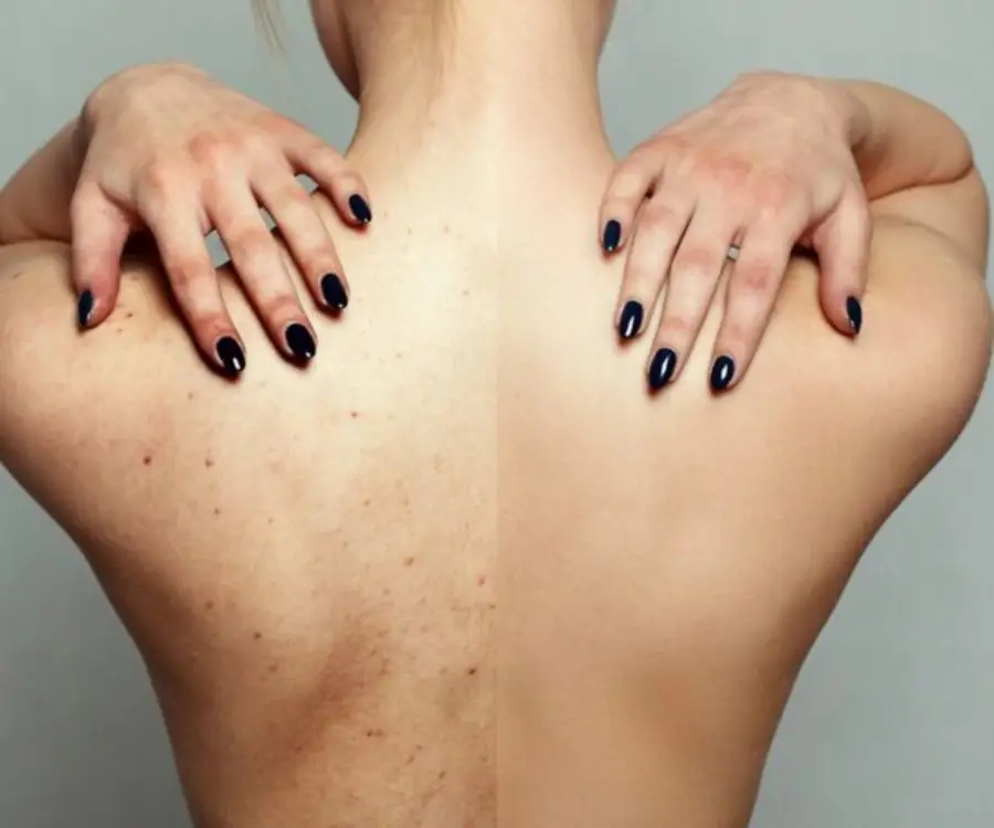 Trattamento Laser Medicale CO2