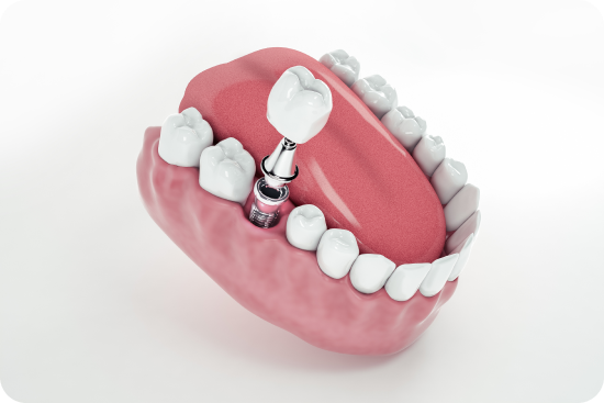 faccette dentali monza e seregno