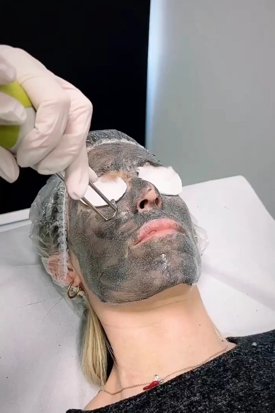 Trattamento Carbon Peeling Seregno